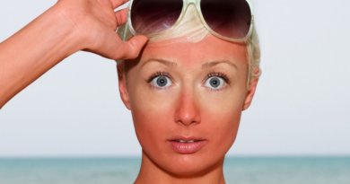 How to remove redness after sunburn? How to remove redness after sunburn?